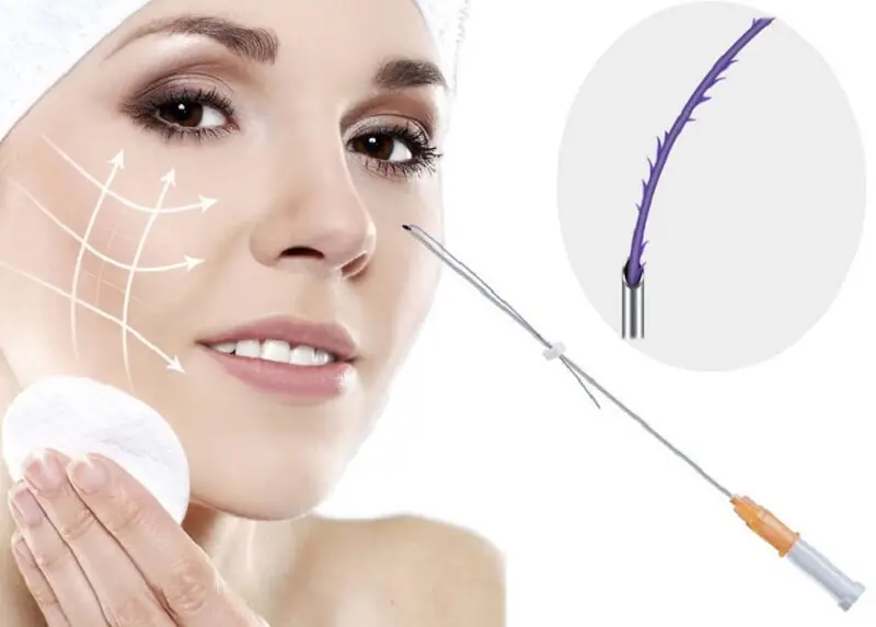 Căng chỉ da mặt sử dụng chỉ sinh học luồn vào bên trong da