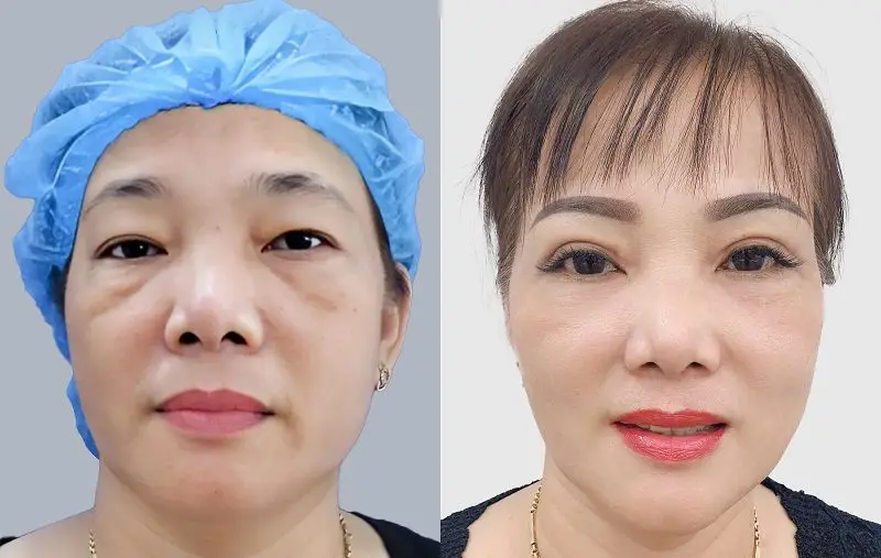 Cắt da dư mí mắt dưới giúp đôi mắt trẻ trung, hài hòa hơn