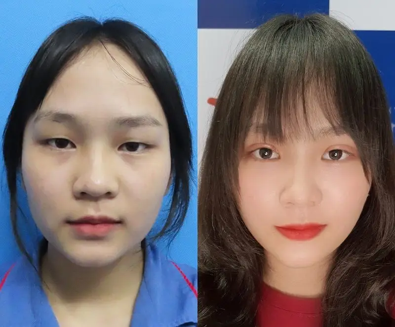 Cắt mí khắc phục được tình trạng mí lót, mí ẩn