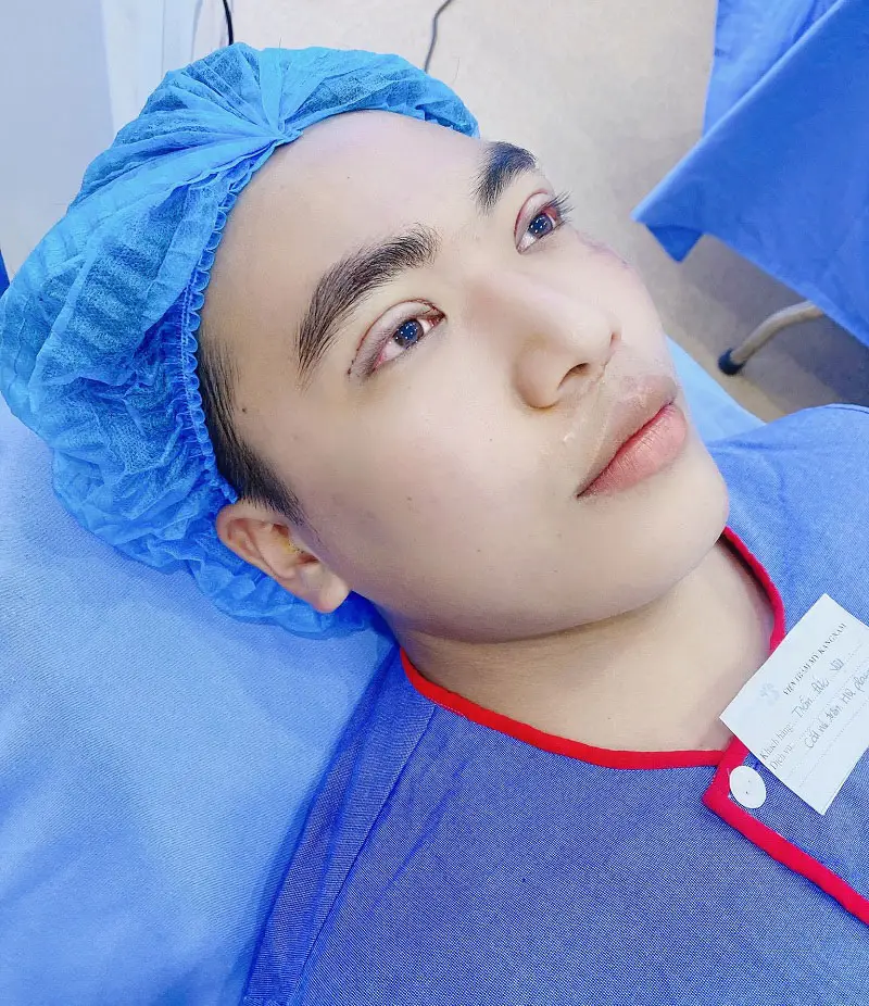 Những ngày đầu sau cắt mí vết thương sẽ bị sưng
