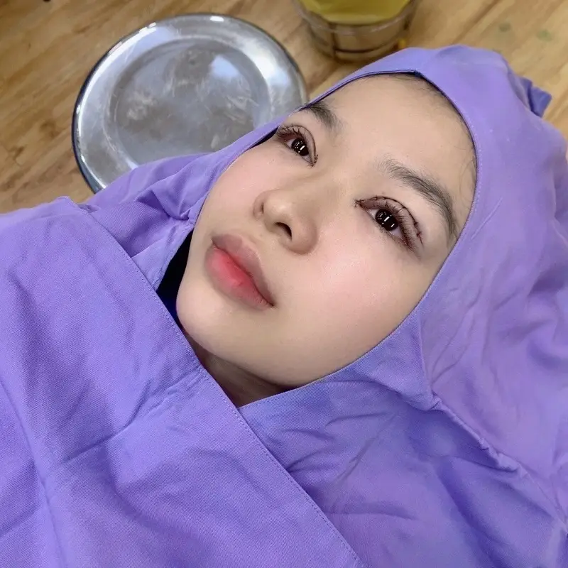 Tình trạng sưng tấy sau cắt mí sẽ hết sau khoảng 5 - 7 ngày