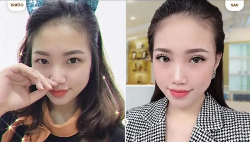 Cắt mí Mini Deep 6D tạo nếp mí to tròn, cân đối