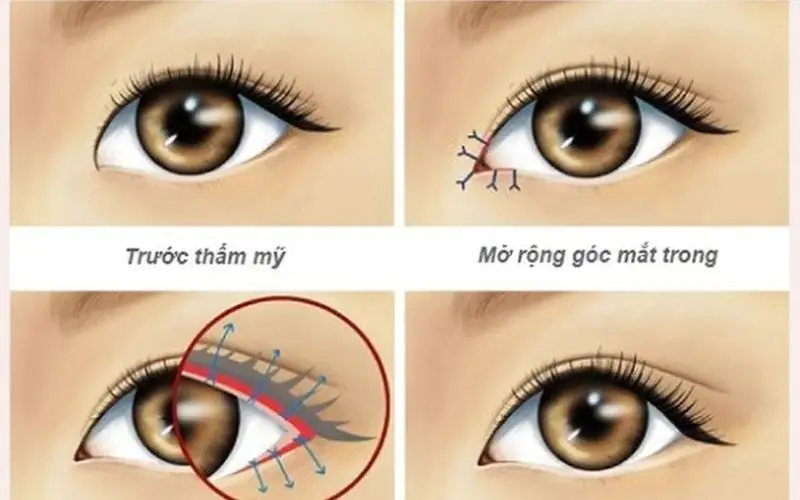 Bác sĩ tạo nếp mí giống mắt phượng hoàng