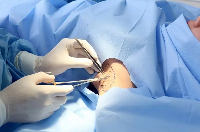Thực hiện cắt tuyến mồ hôi đúng kỹ thuật sẽ không gây biến chứng cho khách hàng