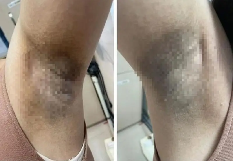 Tăng nguy cơ nhiễm trùng vùng nách khi điều trị tuyến mồ hôi sai cách
