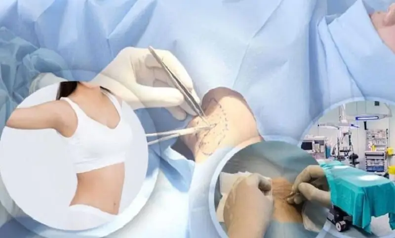 Cắt tuyến mồ hôi nách giúp giảm tình trạng tiết mùi hôi khó chịu