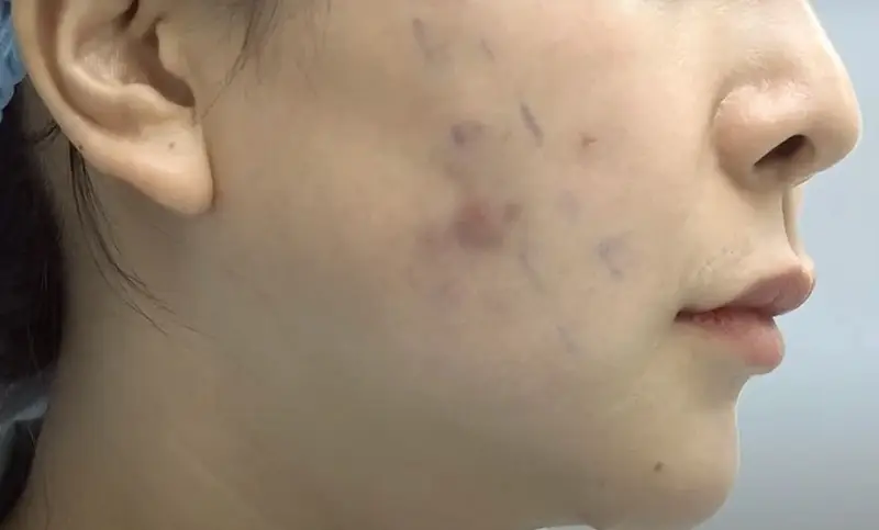 Mặt bị tụ máu, sưng bầm kéo dài