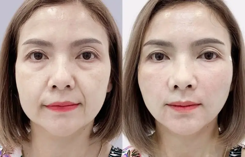 Vùng da được cấy chỉ kích thích sản sinh collegen tươi trẻ hơn