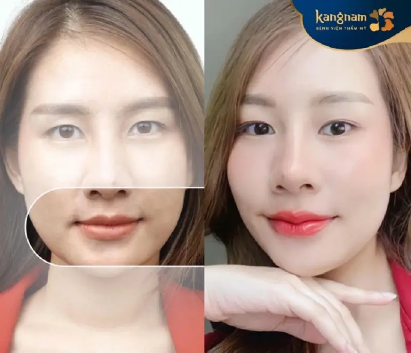 Cấy mỡ môi khắc phục được tình trạng môi mỏng, thiếu sức sống