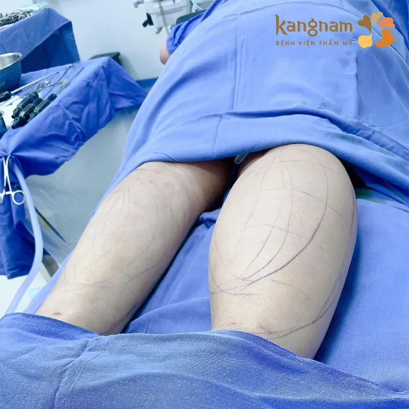 Chi phí hút mỡ bắp chân ảnh hưởng từ nhiều yếu tố khác nhau