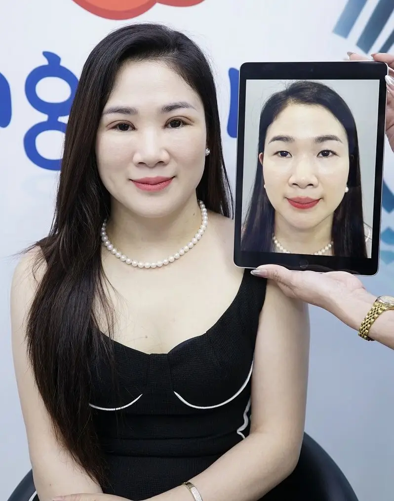 Sau cắt mí khách hàng sở hữu đôi mí mắt rõ nét và cân đối với khuôn mặt