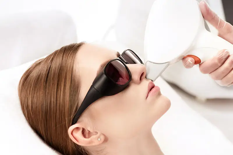 Triệt lông bằng laser không làm lông mọc lại cứng hơn