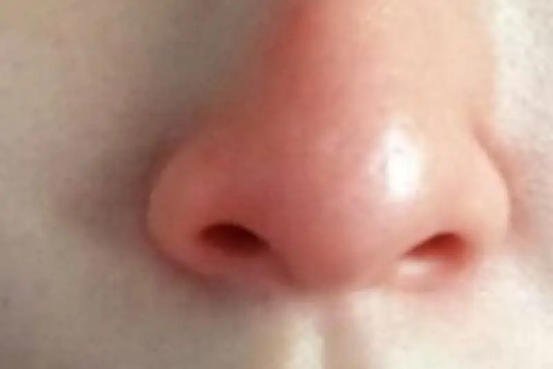 Da mũi mỏng dễ kích ứng