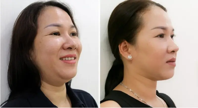 Tiêm tan mỡ mang lại hiệu quả tốt