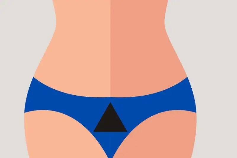 Triệt lông bikini tạo hình tam giác