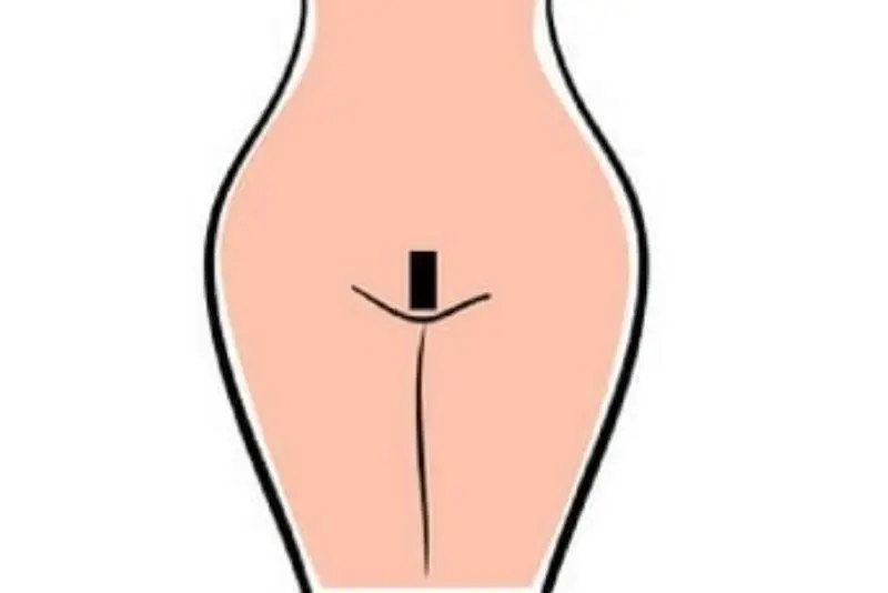 Triệt lông bikini kiểu chữ nhật