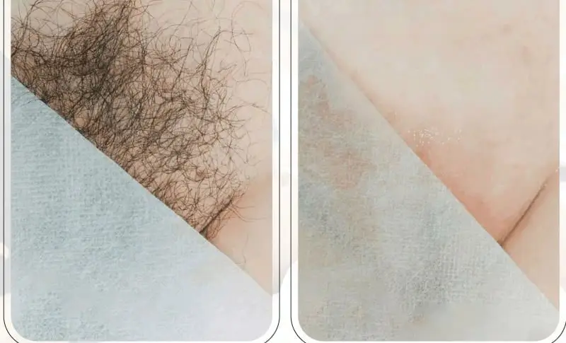 sau triệt lông thường thấy da sạch hơn, không còn các nốt đỏ do lông mọc ngược