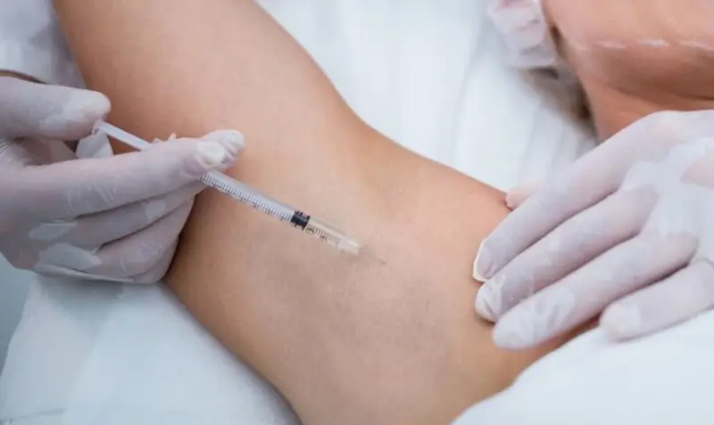 Tiêm botox là cách điều trị hôi nách tạm thời