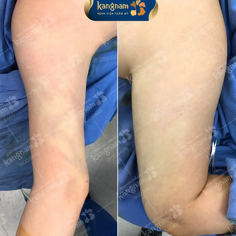 Sau hút mỡ cánh tay khách hàng sẽ gặp tình trạng sưng phù