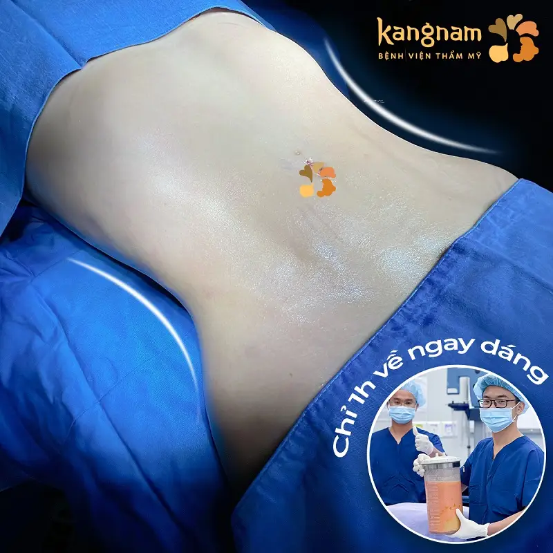 Hút mỡ bụng dưới đảm bảo an toàn khi thực hiện tại cơ sở thẩm mỹ uy tín