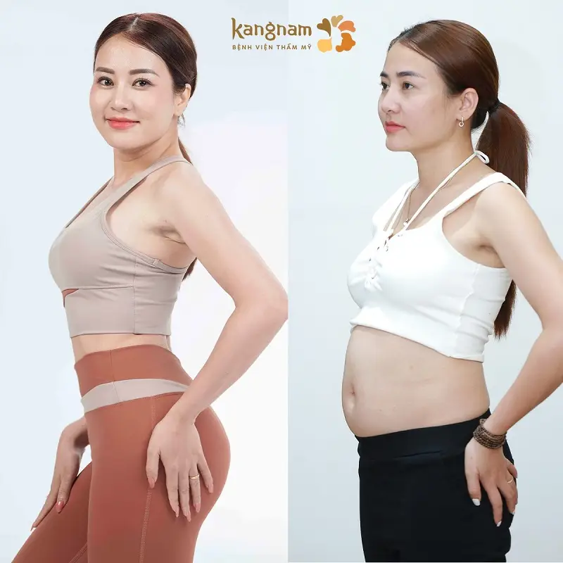 Khách hàng sở hữu vóc dáng thon gọn, cân đối sau khi hút mỡ bụng