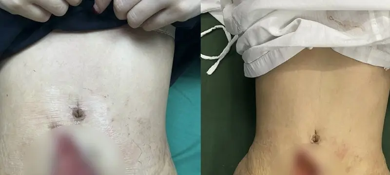 Hút mỡ sẽ xảy ra biến chứng nếu không được thực hiện tại cơ sở thẩm mỹ uy tín