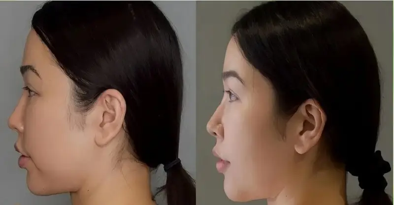 Quá trình hút mỡ má khách hàng được gây tê nên không cảm thấy đau