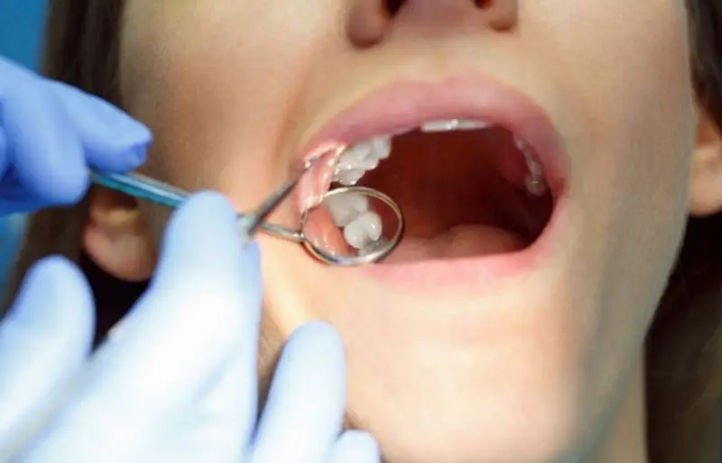 Nhổ răng khôn sẽ gây đau sau khi hết thuốc tê