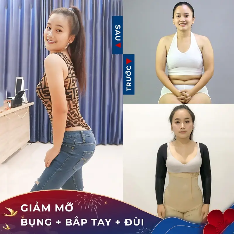 Hút mỡ toàn thân chỉ xảy ra biến chứng khi quá trình thực hiện không đảm bảo an toàn