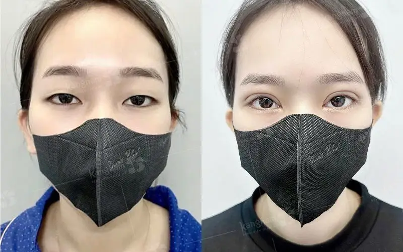 Cắt mí tạo đường rạch ở cung mí mắt, khắc phục được mọi khuyết điểm như mí ẩn, mí sụp