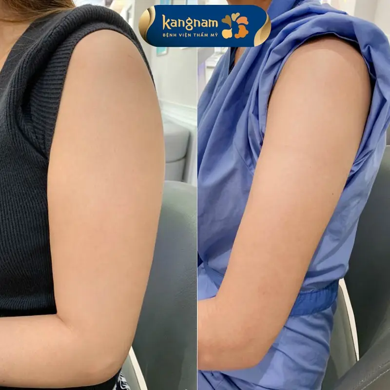 Bắp tay nhanh chóng thon gọn, sau hút mỡ