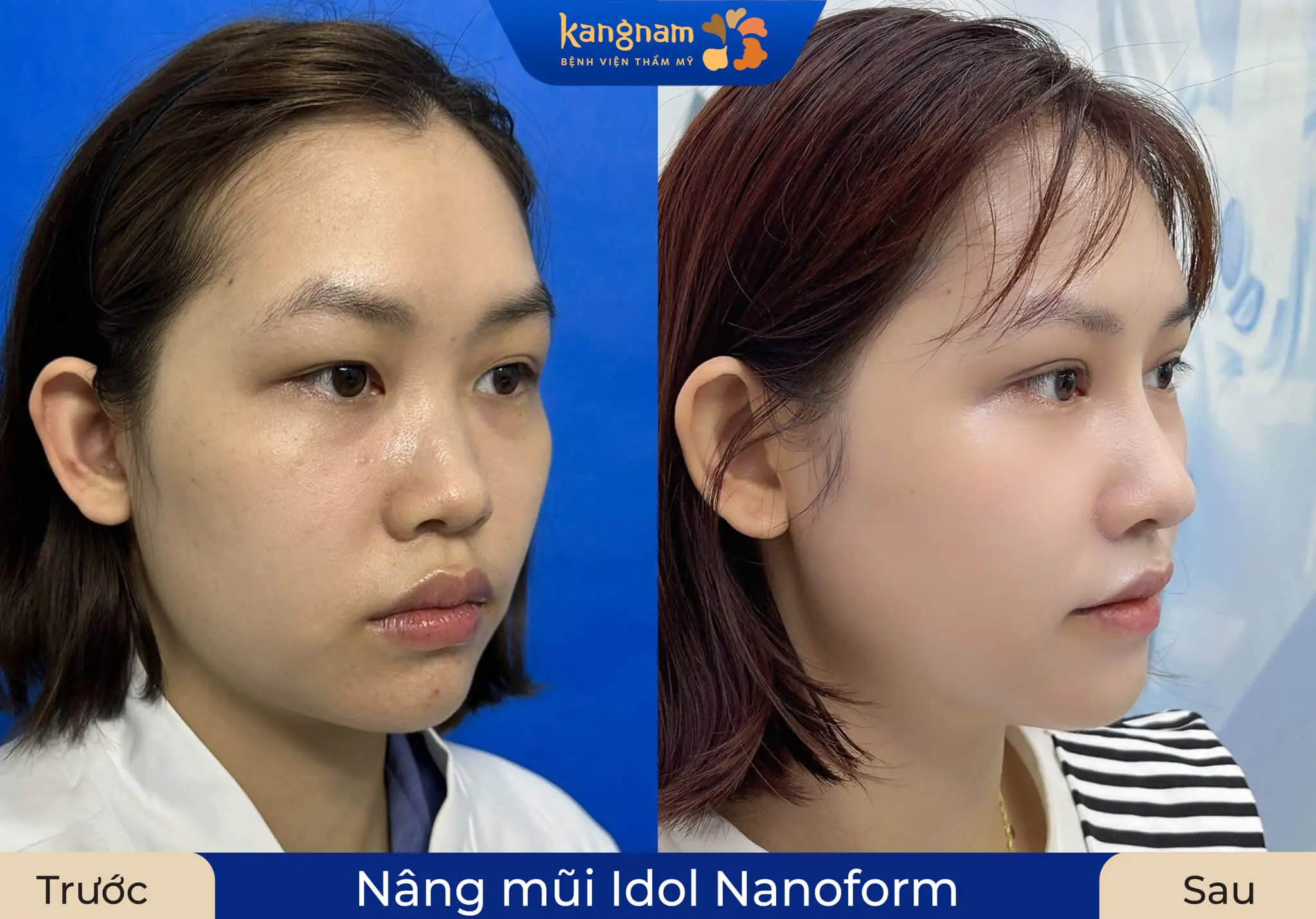 Nâng mũi cấu trúc khắc phục toàn diện khuyết điểm cho người có da mũi mỏng