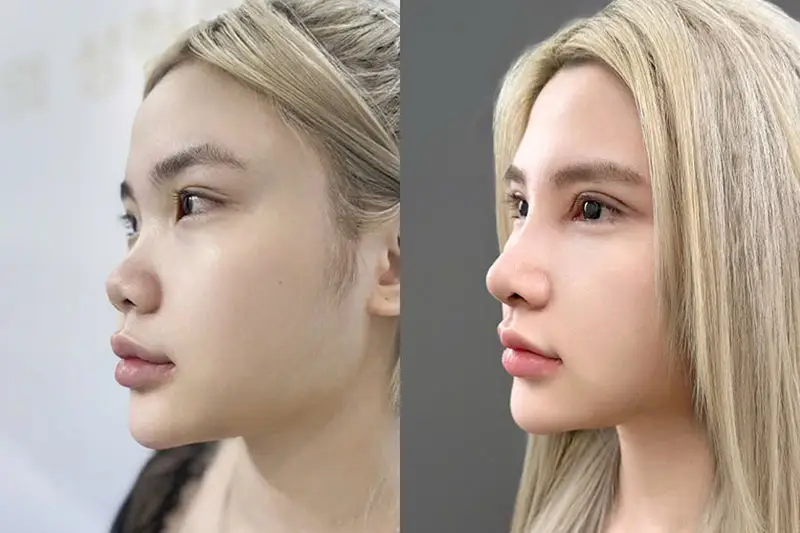 Nâng mũi cấu trúc có kết quả bền vững, dáng mũi ổn định sau nhiều năm