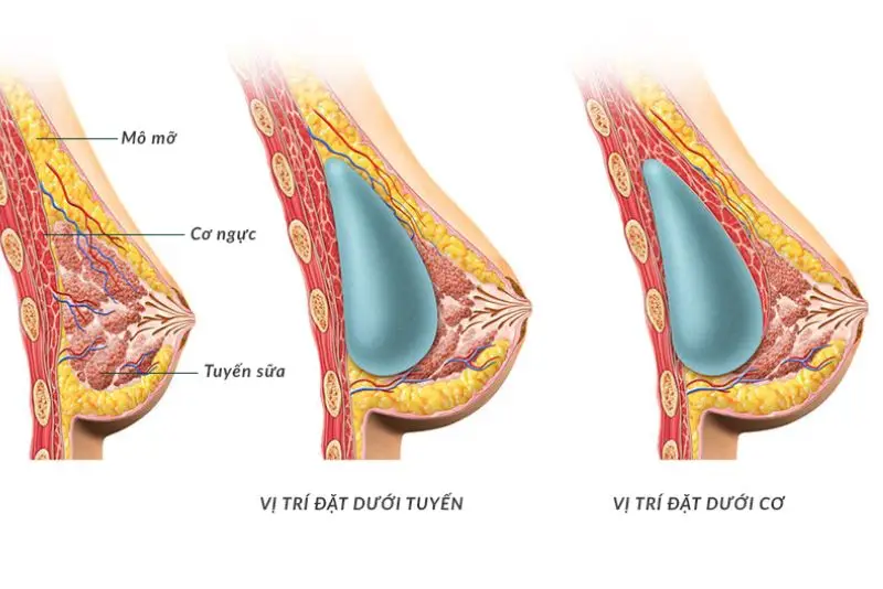 Nâng ngực không ảnh hưởng đến chức năng vùng ngực