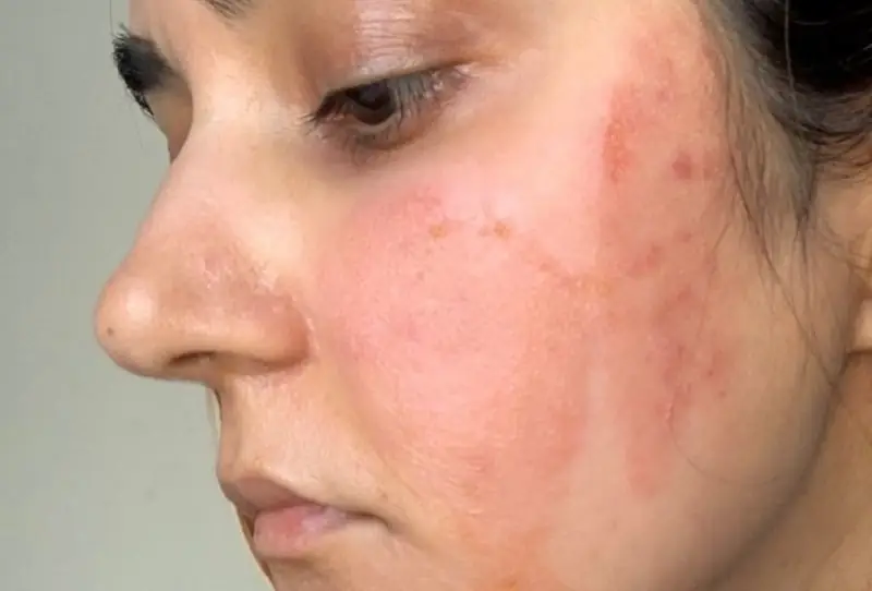 Peel da bị bỏng rát khó chịu kéo dài