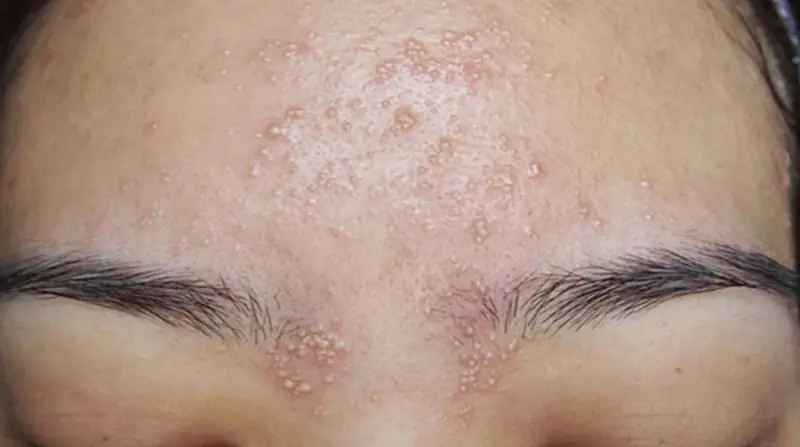 Da nổi mụn chi chít sau khi peel