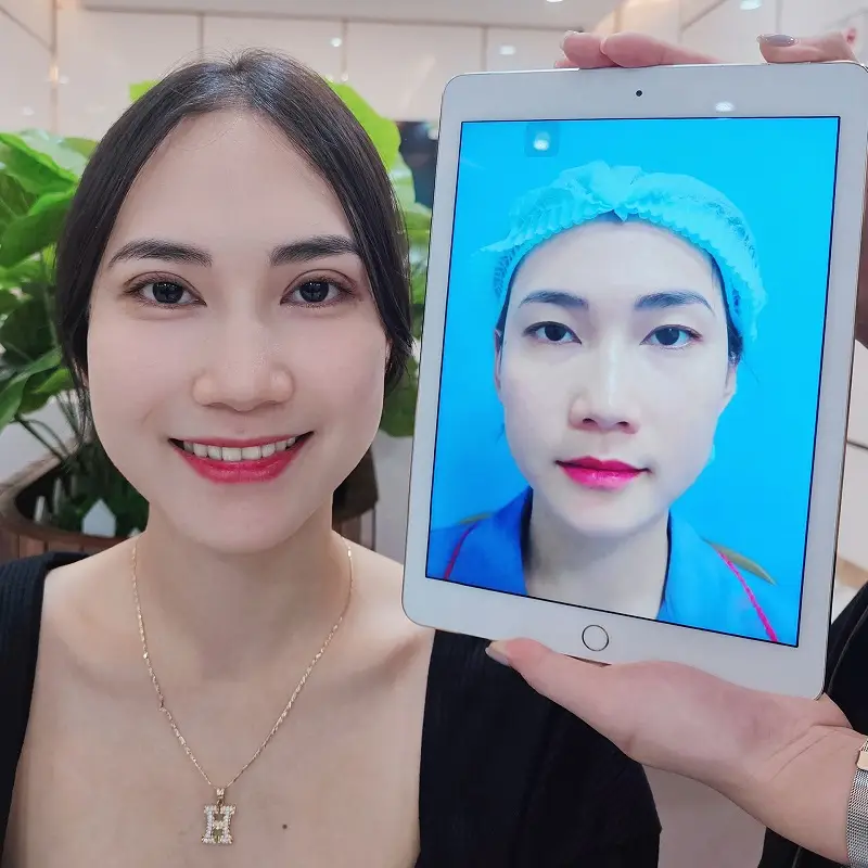 Sau cắt mí khách hàng sở hữu đôi mắt to tròn, cân đối