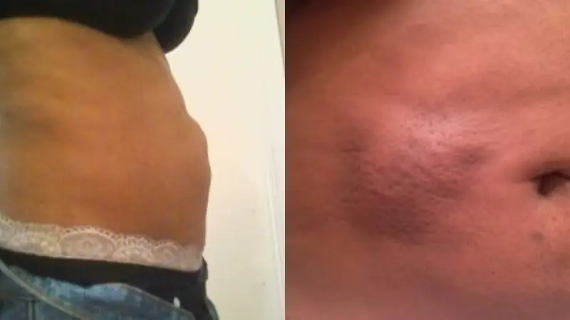 Phù nề sau hút mỡ là tình trạng thường gặp