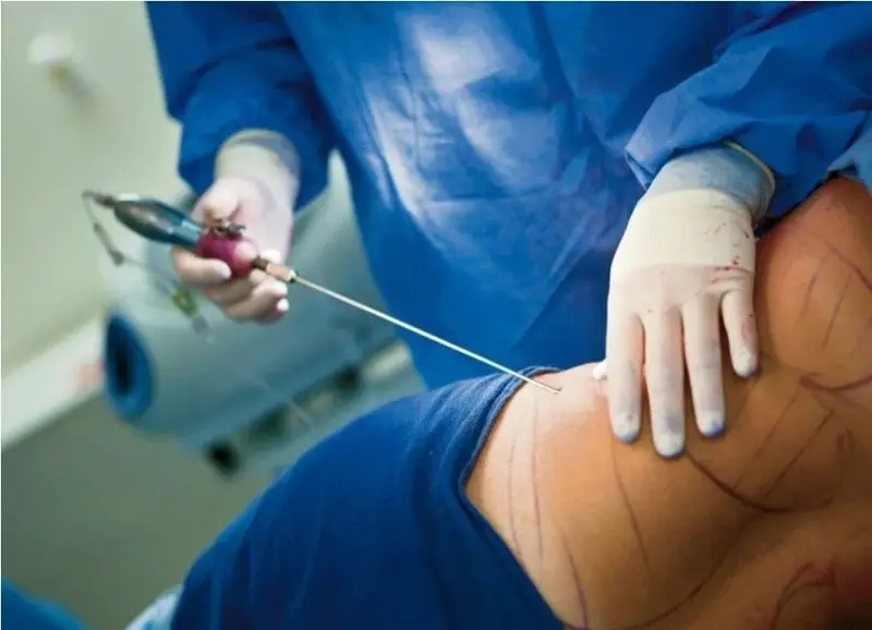 Cơ thể phản ứng sưng phù sau khi hút mỡ