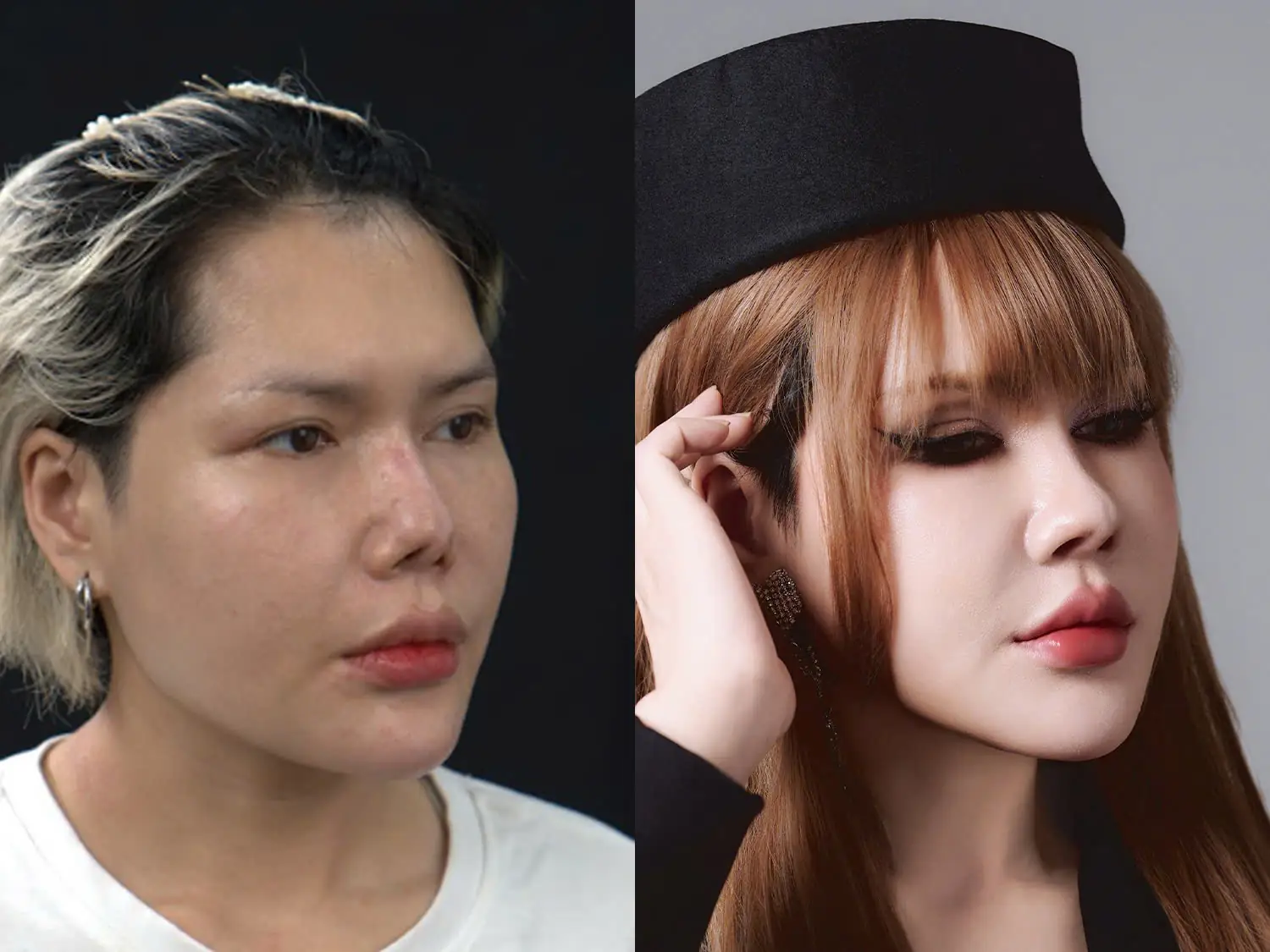 Quỳnh Mai bị biến dạng mũi nặng nề, đầu mũi rách sẹo lõm, sau khi phẫu thuật sở hữu dáng mũi hoàn thiện, thon gọn và an toàn
