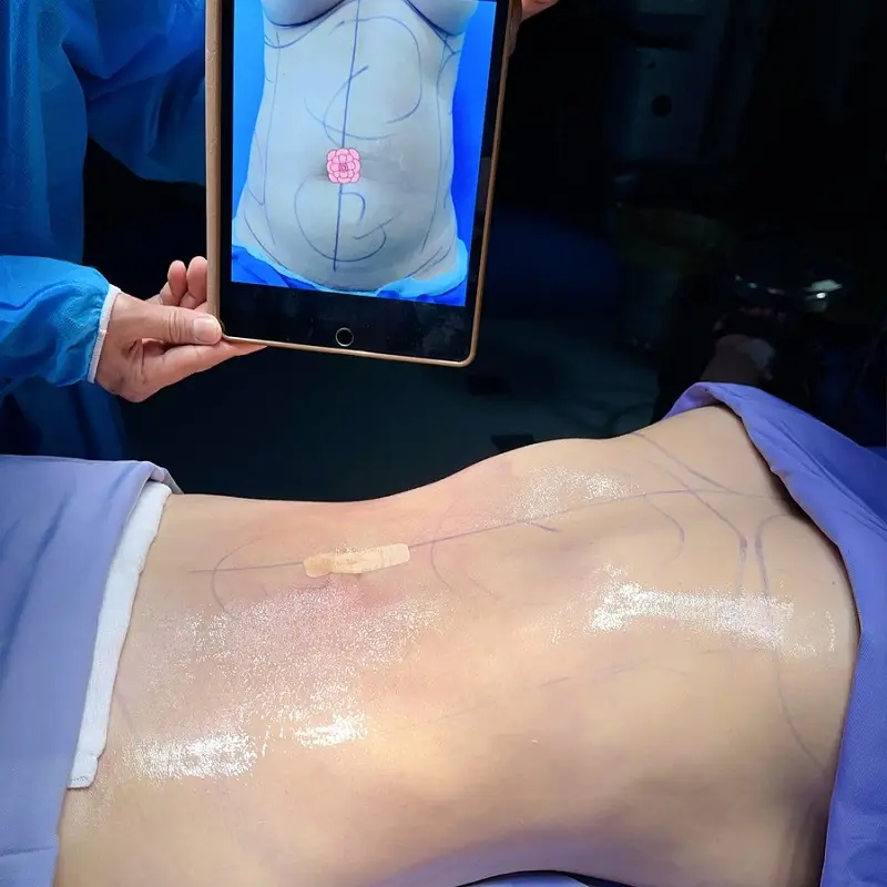 Vùng bụng sau khi mới hút mỡ sẽ hơi sưng