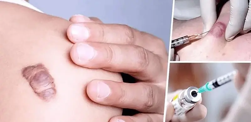 Corticosteroid có tác dụng làm giảm kích thước của sẹo lồi
