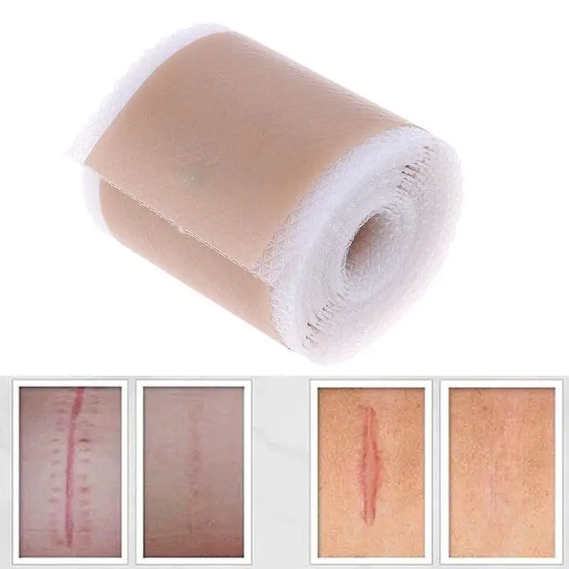 Băng ép Gradient có công dụng ngăn ngừa sẹo tái phát
