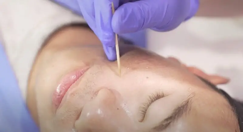 Chấm TCA có hiệu quả lấp đầy sẹo lõm