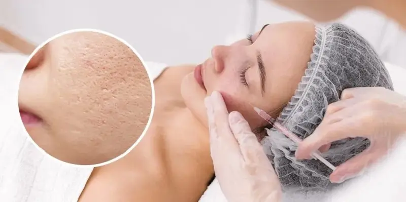 Tiêm meso giúp làm đầy và trẻ hóa làn da bị sẹo lõm