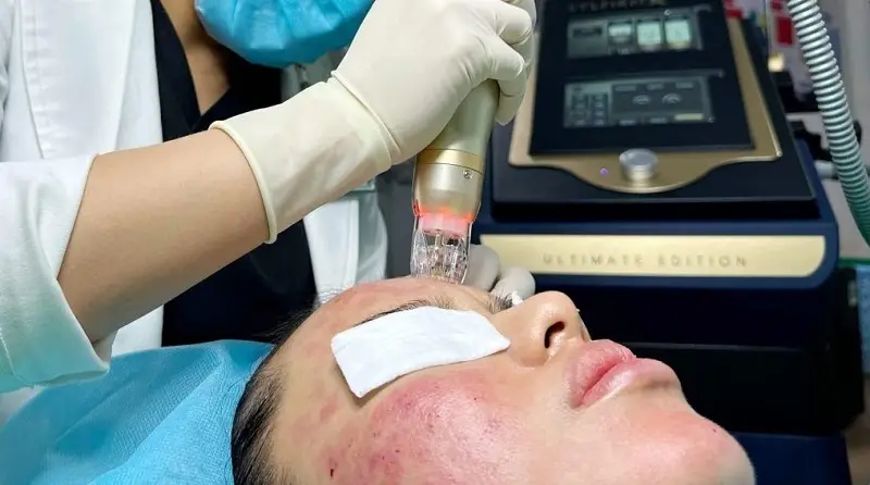 RF siêu vi điểm kích thích sản sinh collagen