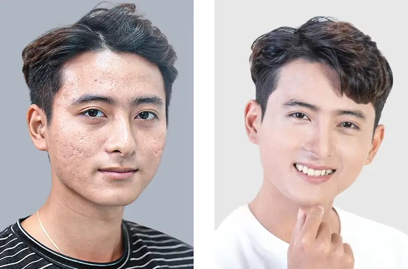 Những người bị sẹo lõm khi áp dụng được đúng phương pháp điều trị sẽ giúp làn da mịn màng, tươi sáng hơn