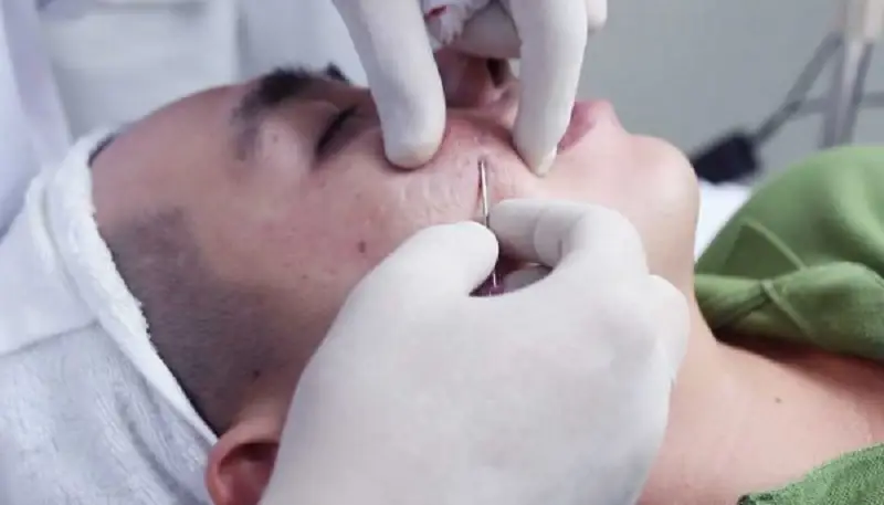 Bóc tách đáy sẹo loại bỏ sẹo lõm xơ cứng