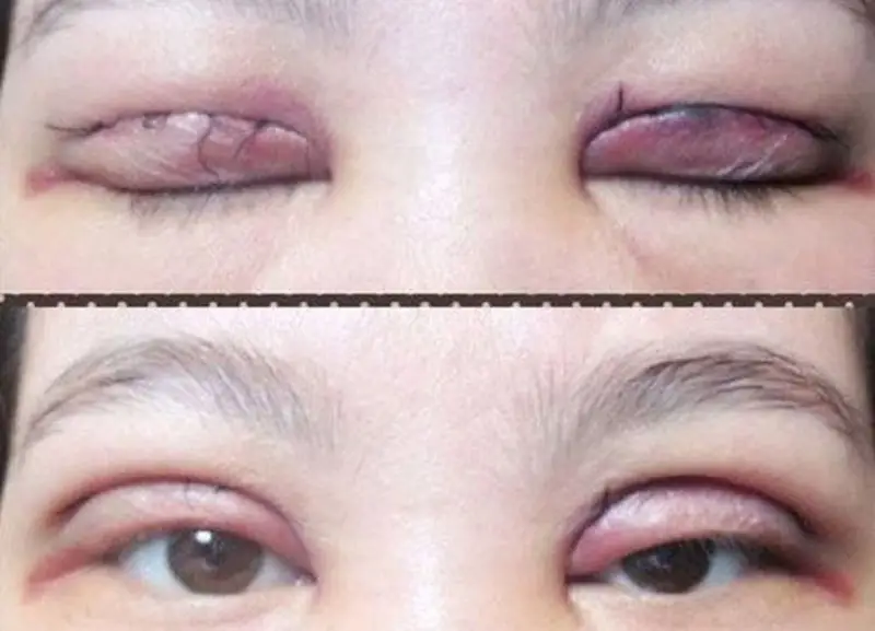 Mí mắt bị hỏng sau khi cắt mí không thành công