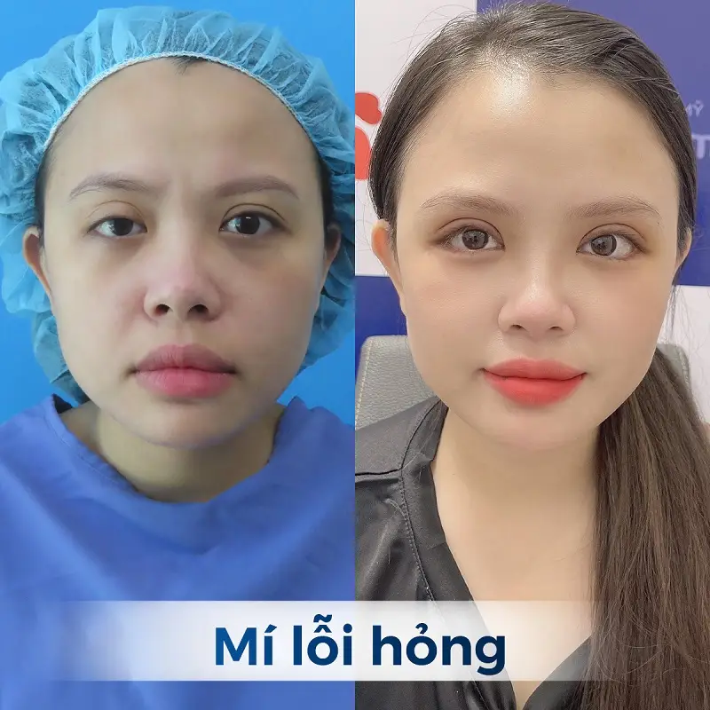 Tình trạng mí lỗi, hai mí không đều
